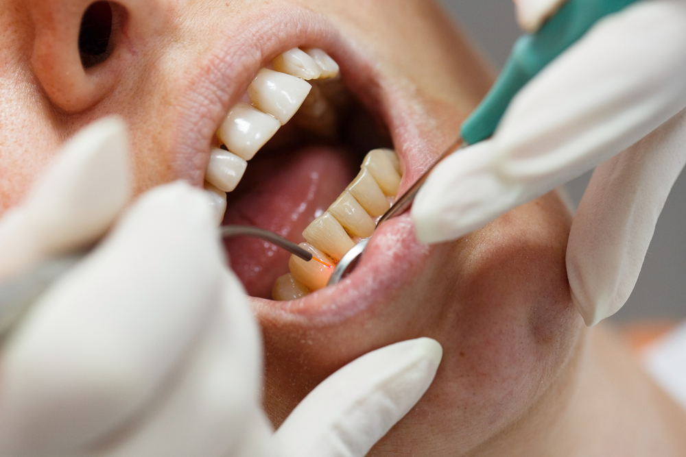 Fighting Gum Disease with LANAP Laser Therapy